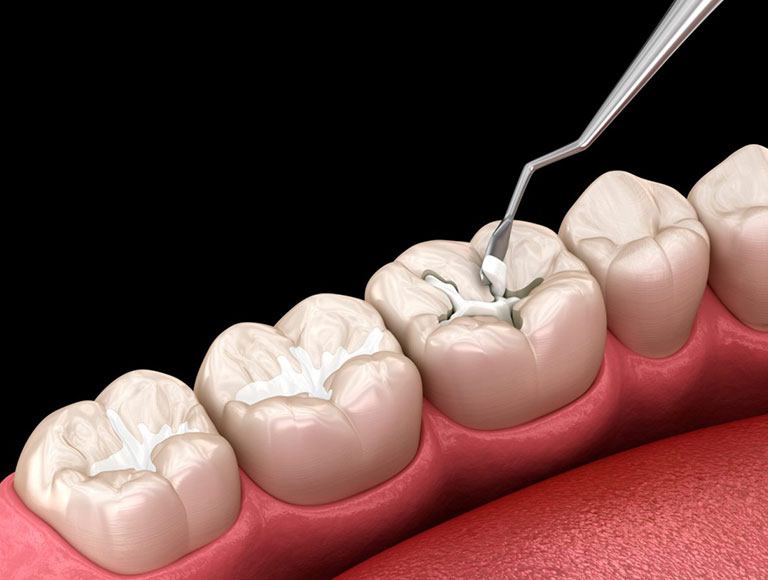 Needs Dental Sealants